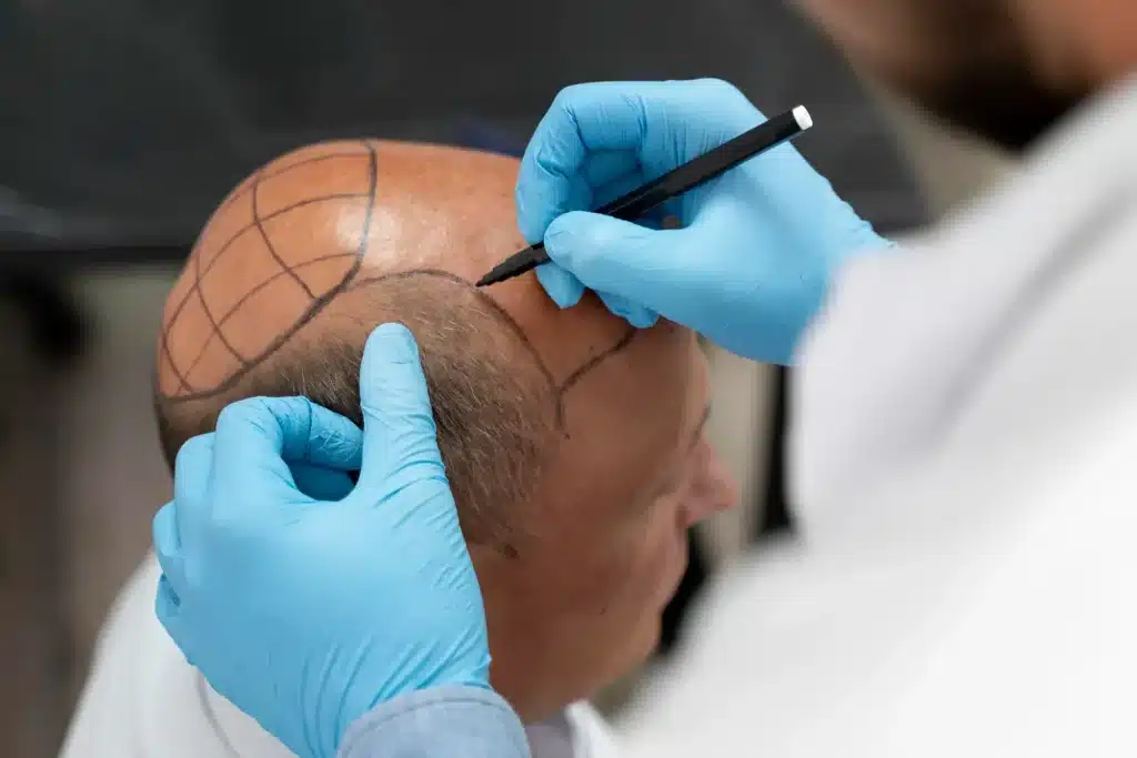 hair transplant in turkey cost