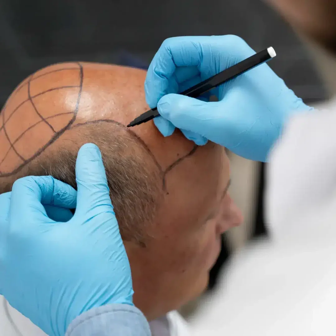 Hair Transplant in Turkey Cost & Packages