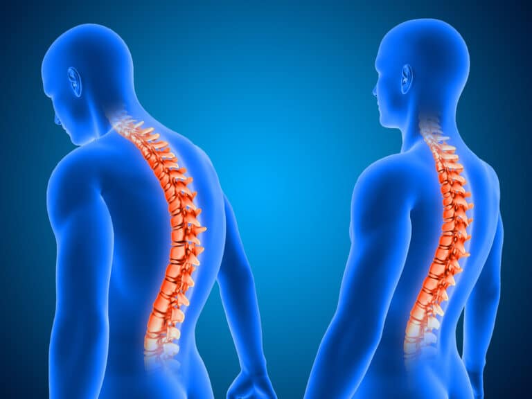 Spine Surgery in India Cost