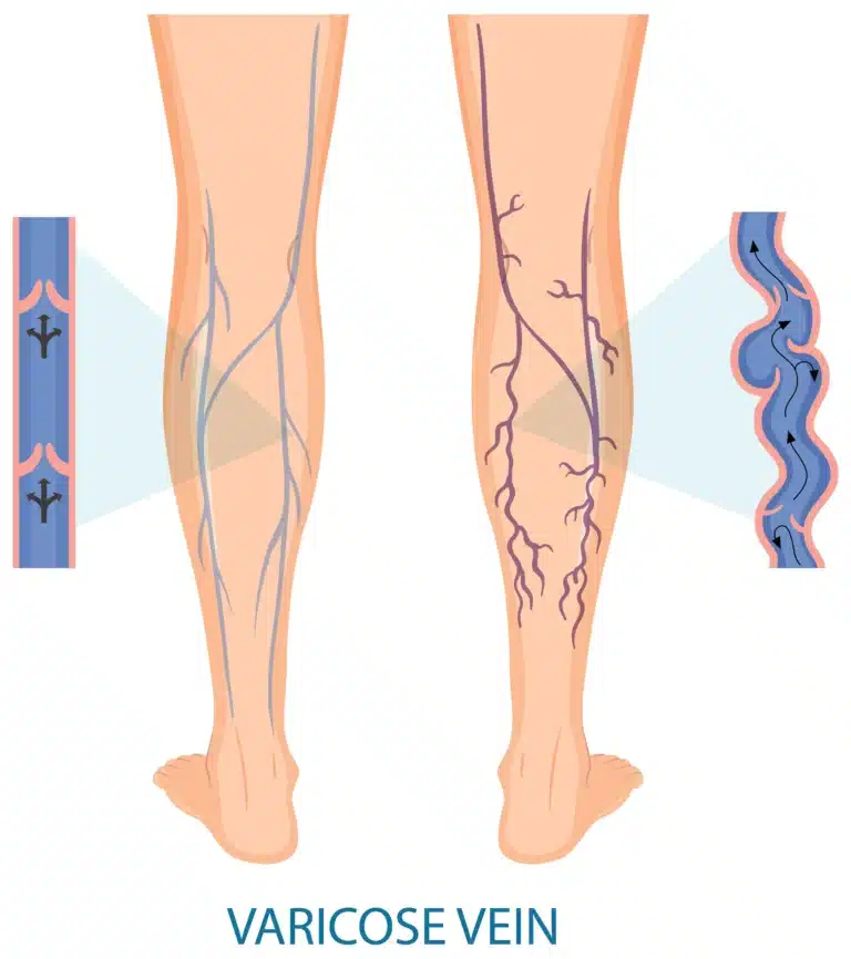 Best Hospitals for Varicose Veins Treatment in India