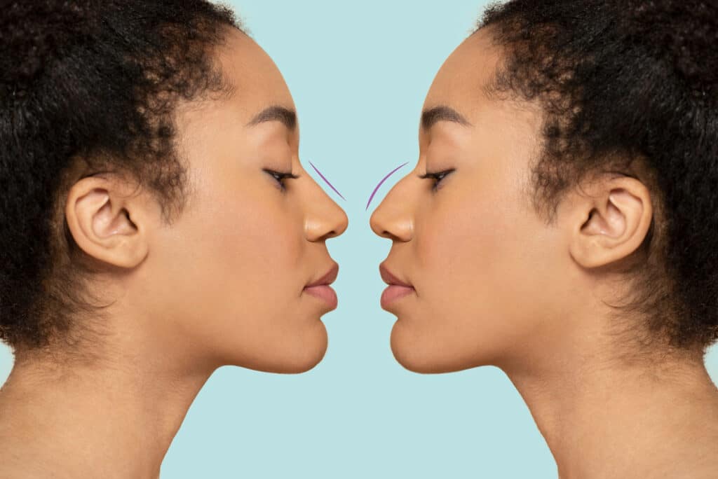 Nose Plastic Surgery Dubai Price - Rhinoplasty