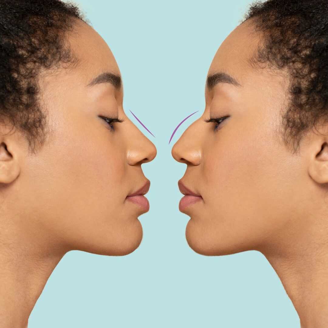 Nose Plastic Surgery Dubai Price – Rhinoplasty