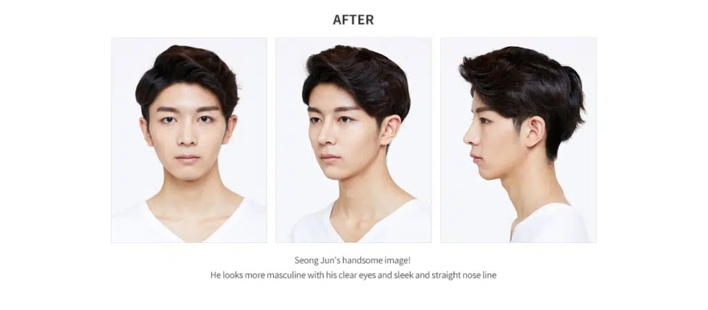 ソンジュン整形手術後