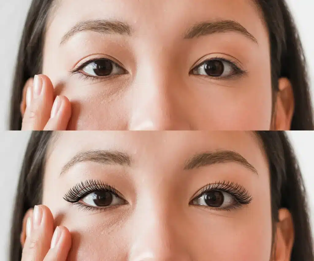Asian eyelid surgery before and after photo