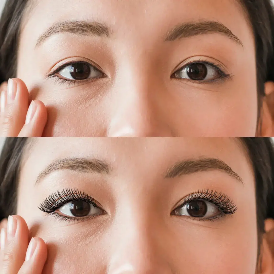Korean Eyelid Surgery Before and After – (Asian Blepharoplasty)