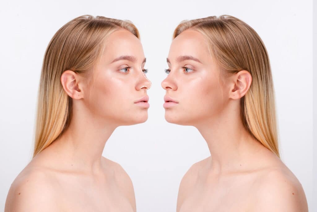 Rhinoplasty in Turkey Cost with Clinics
