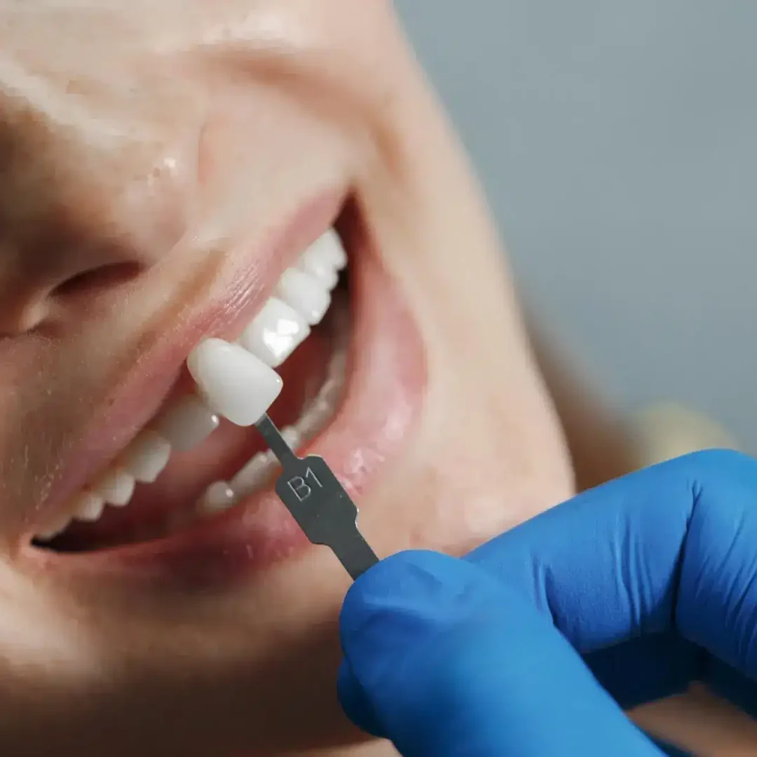 Cheapest Places to Get Veneers in the World