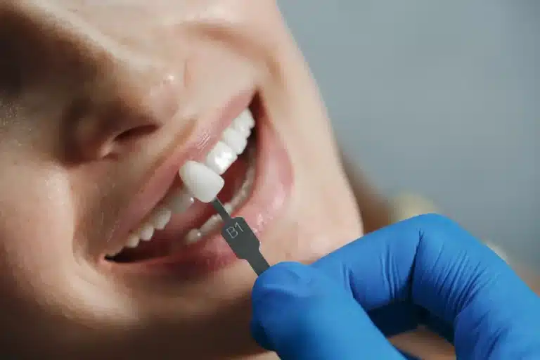 cheapest places to get veneers