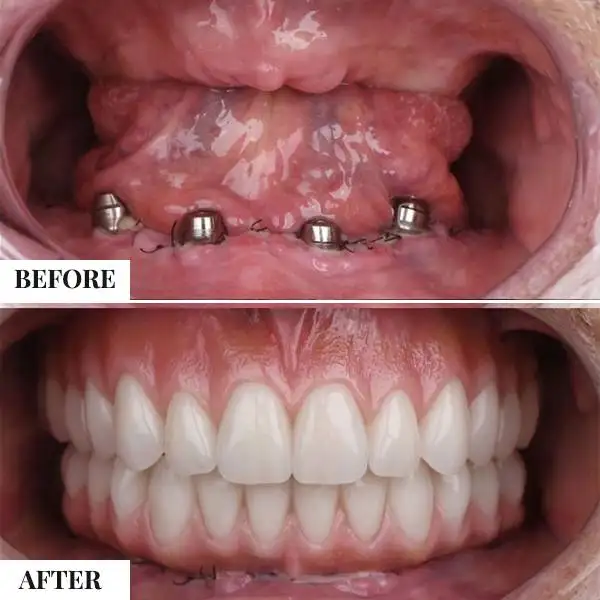 full mouth dental implants in colombia