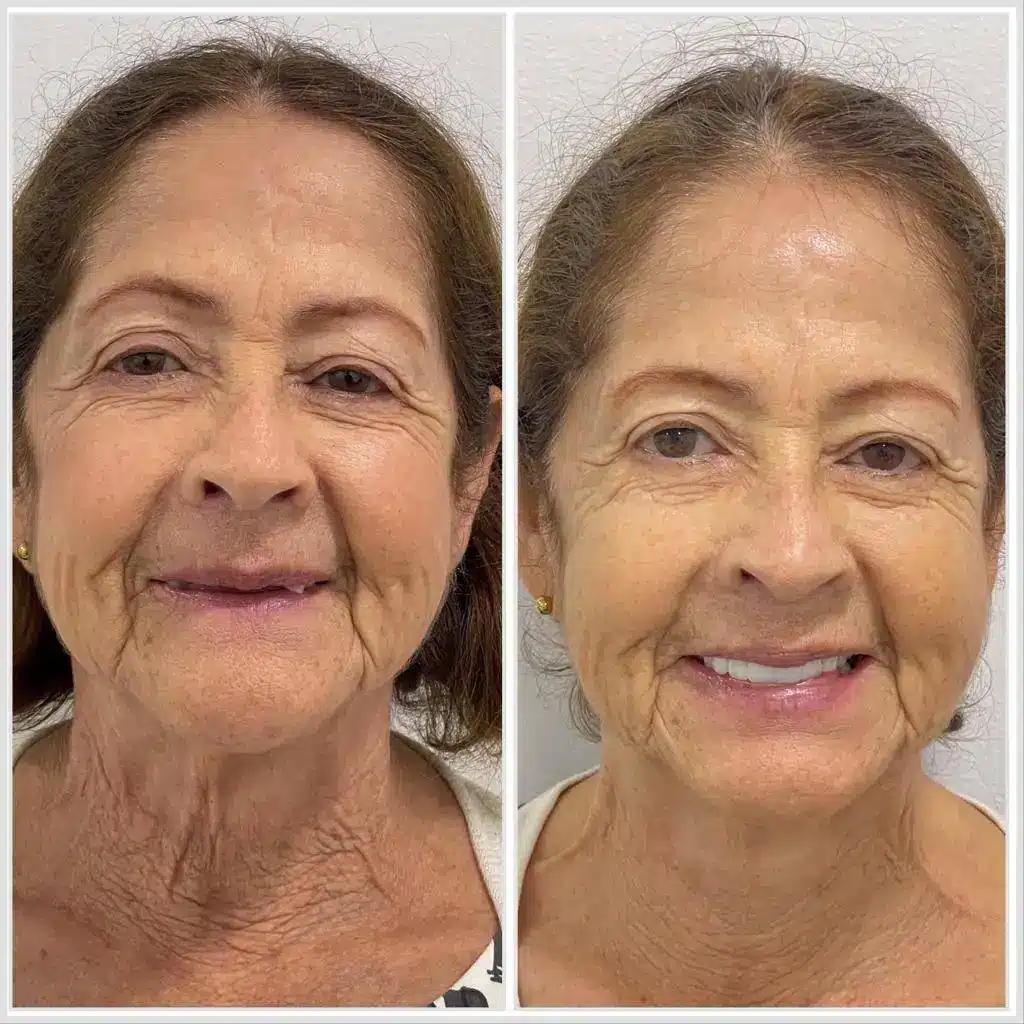 full mouth dental implants in colombia