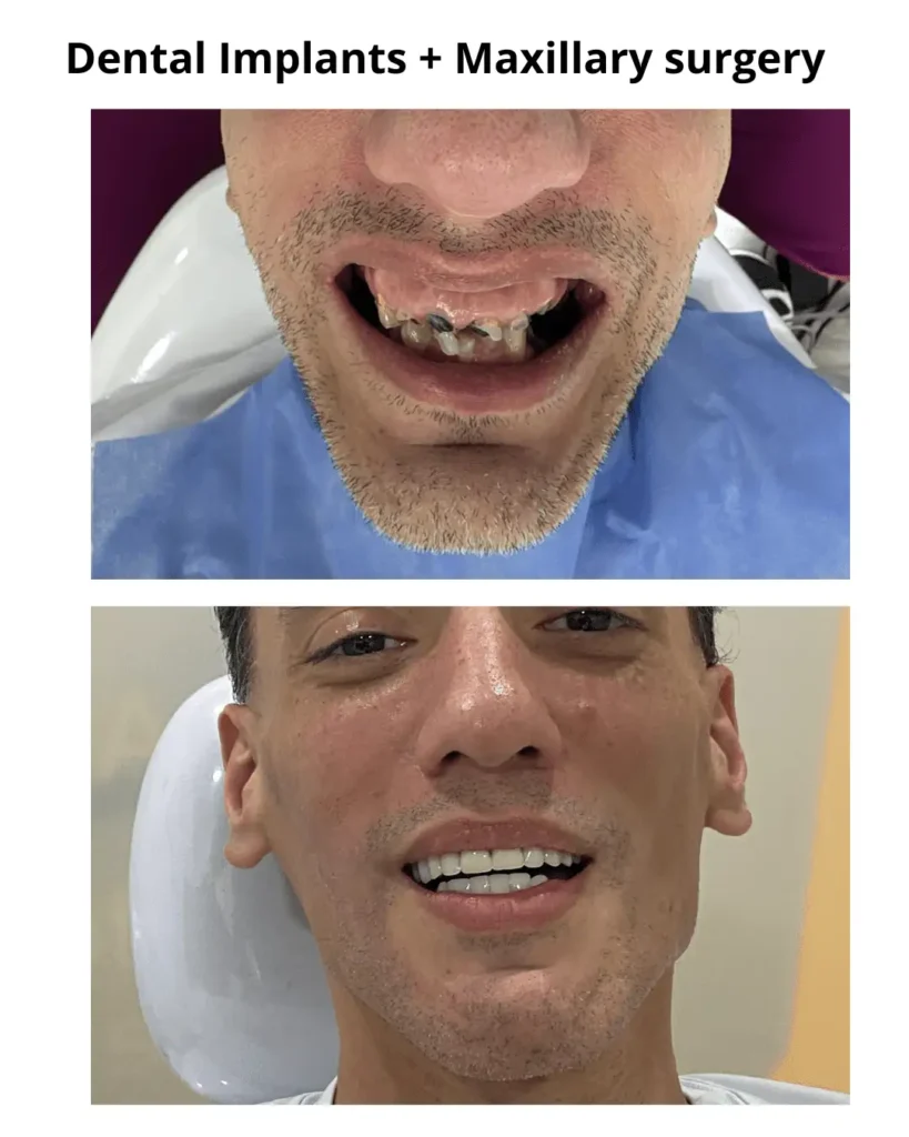 full mouth dental implants in colombia
