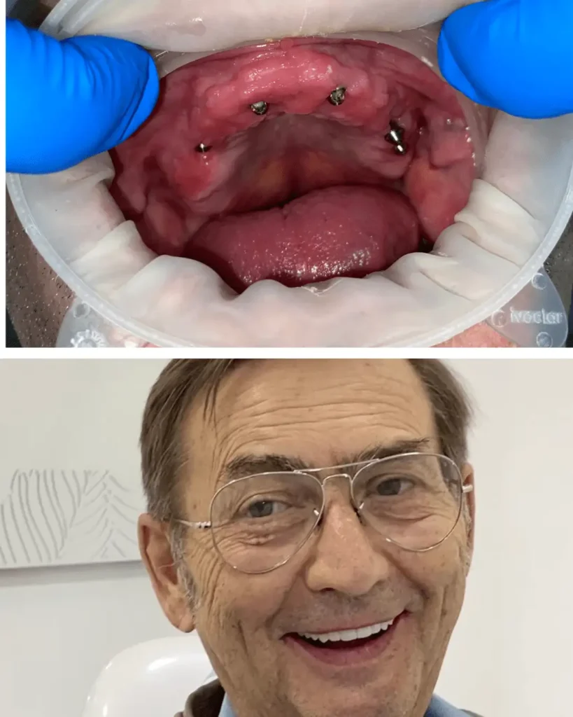 full mouth dental implants in colombia