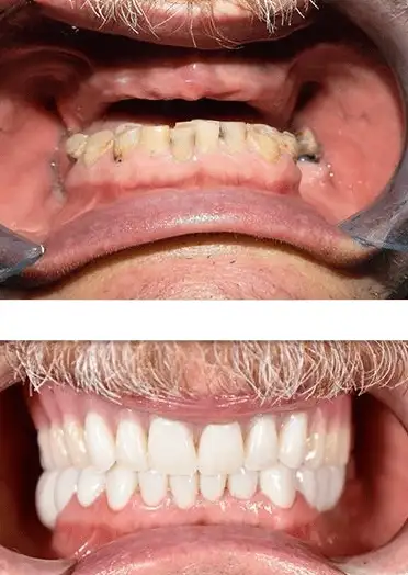 full mouth dental implants in colombia