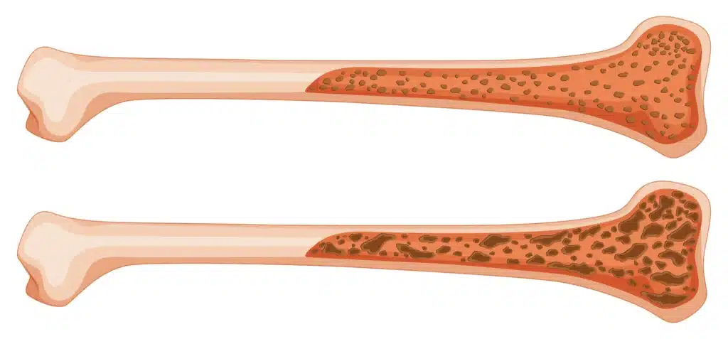 Bone Marrow Transplant in India Cost