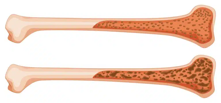 Bone Marrow Transplant in India Cost