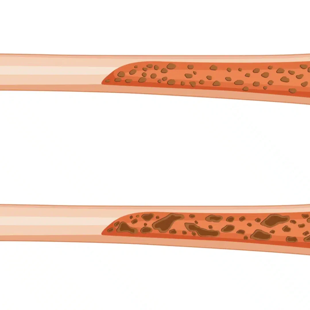 Bone Marrow Transplant in India Cost