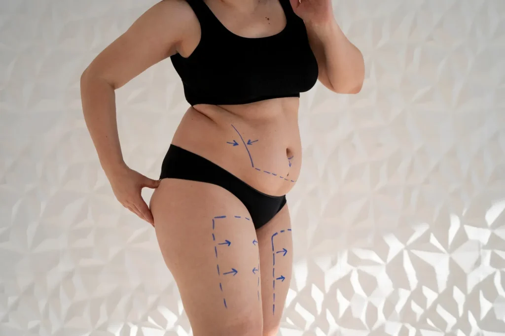 Liposuction in Thailand Cost - Full Body & 360 Lipo