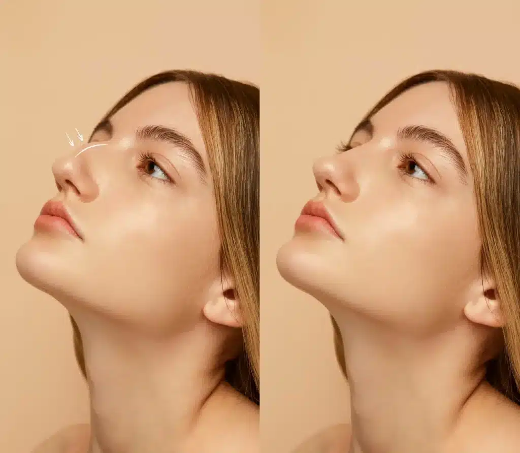 Rhinoplasty (Nose Job) in Spain: Costs with Clinics