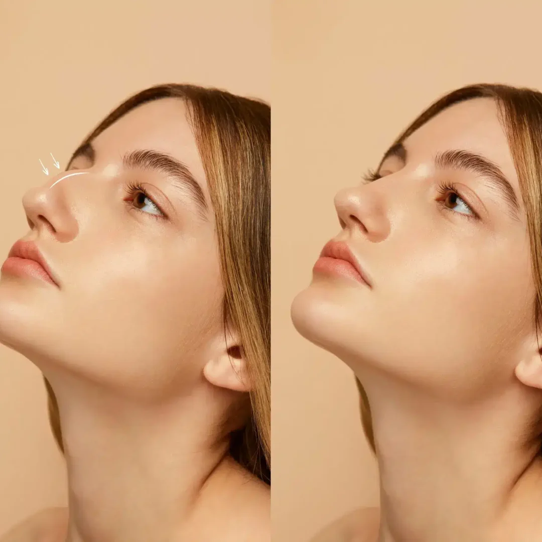 Rhinoplasty (Nose Job) in Spain: Costs with Clinics