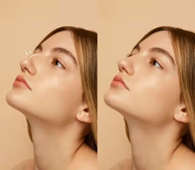Rhinoplasty (Nose Job) in Spain: Costs with Clinics