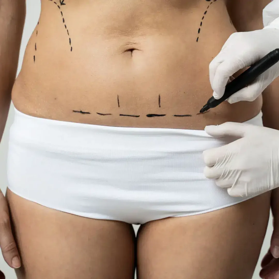 Liposuction in Mexico Cost with Clinics