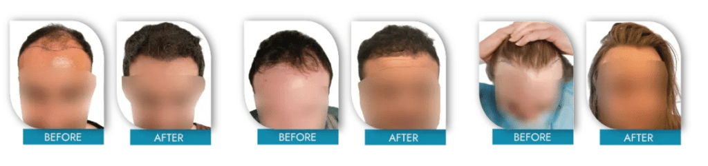 hair transplant before and after