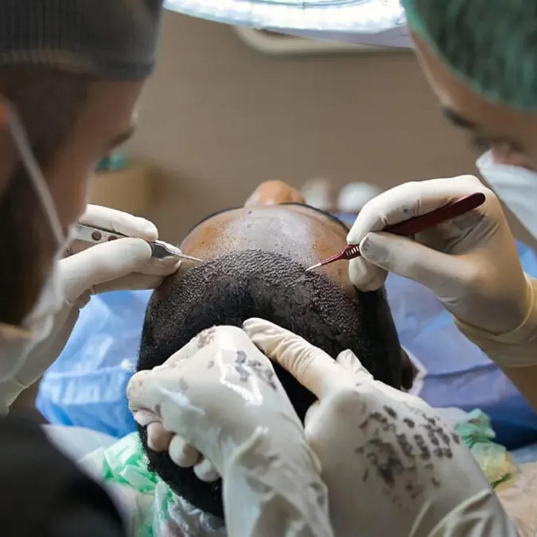 Hair Transplant in Dublin, Ireland Cost with Clinics